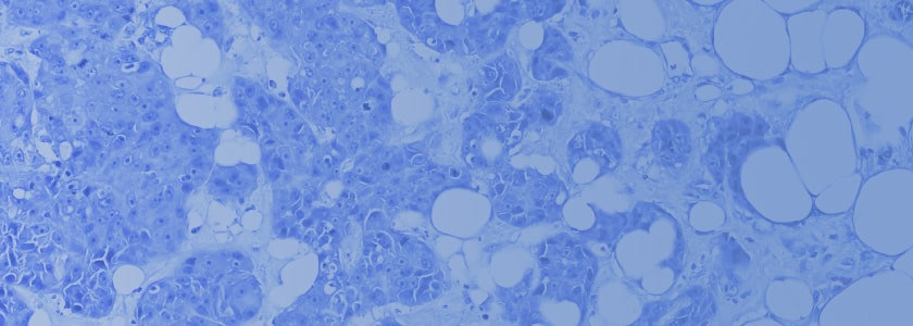 Advanced NGS solutions for cancer research