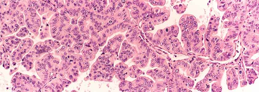 Ovarian cancer and NGS testing: Are some ovary removals unnecessary?